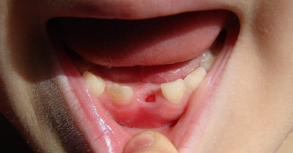 سقوط أسنانك السفلى في المنام تعبير عن ذهاب سنوات التعب و المشقة بلا رجع