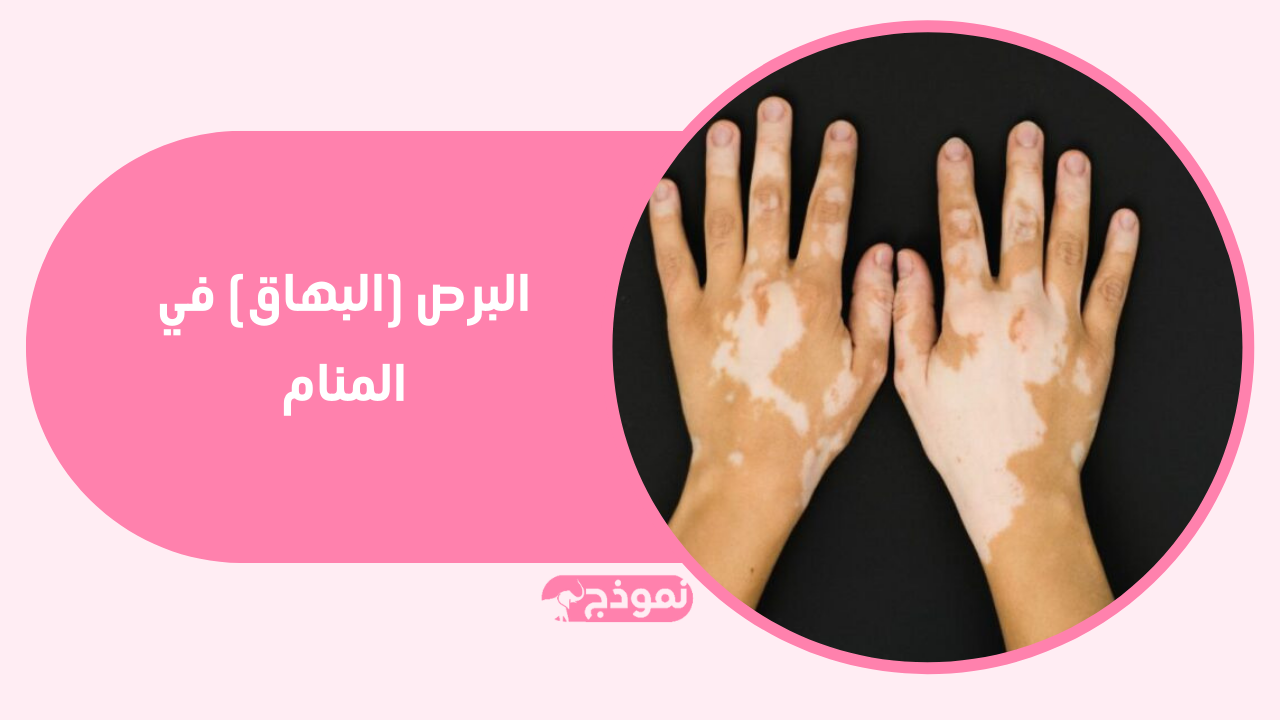 تفسير حلم البهاق أو البرص في اليد أو الكف